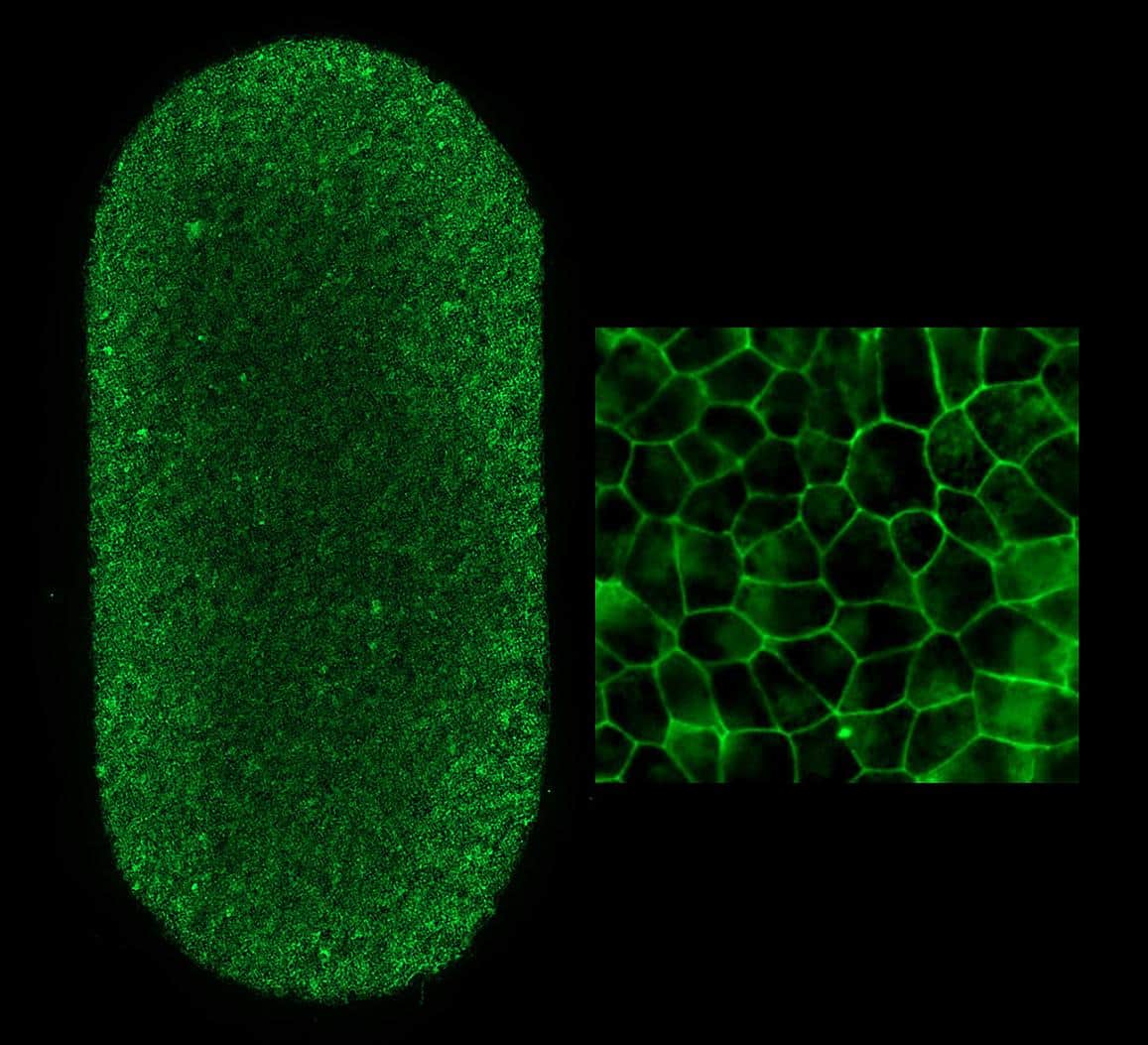 First US Patient Receives Patient-Derived Implant to Treat a Leading Vision Loss Cause