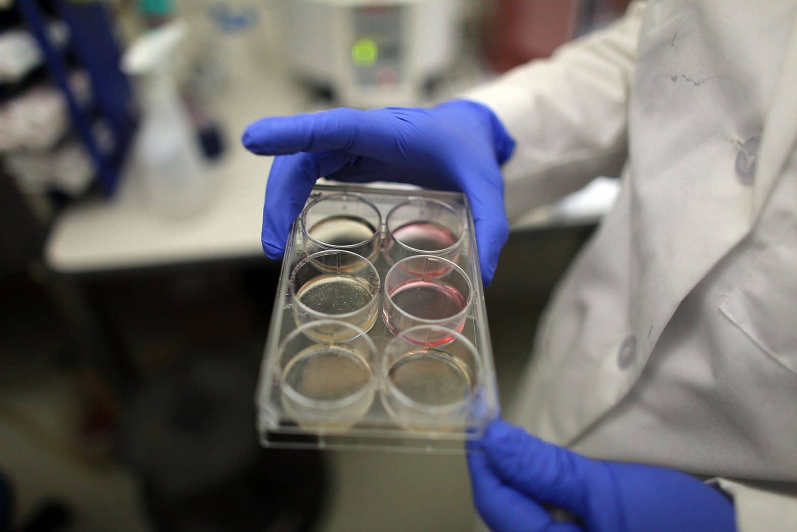 Stem Cell Transplant Shows Success at HIV Remission in Fourth Patient