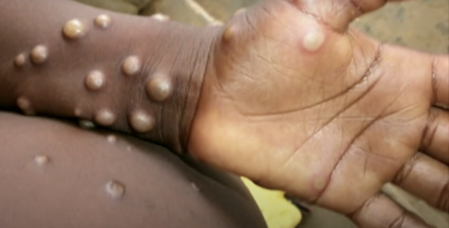 WHO to Decide if Monkeypox Constitutes Public Health Emergency 