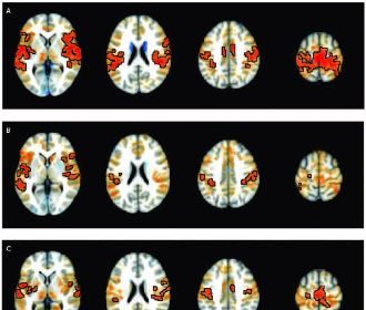 Researchers Identify Brain Connections Associated with ADHD