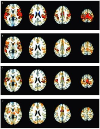 Researchers Identify Brain Connections Associated with ADHD
