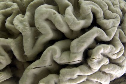 Silent Brain Changes Precede Alzheimer’s. Researchers Have new Clues About Which Come First