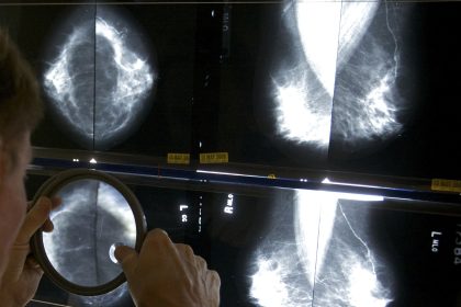 Mammograms Should Start at 40 to Address Rising Breast Cancer Rates at Younger Ages, Panel Says