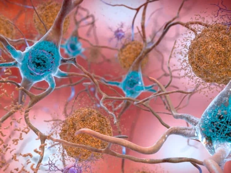 Experimental Drug Appears to Slow Down Alzheimer’s Disease