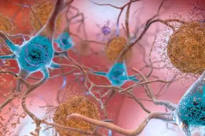 Experimental Drug Appears to Slow Down Alzheimer’s Disease