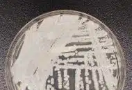 Superbug Fungus Cases Rose Dramatically During Pandemic