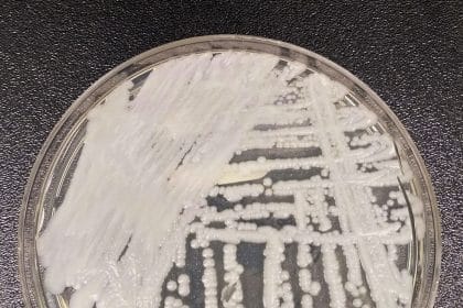 Superbug Fungus Cases Rose Dramatically During Pandemic